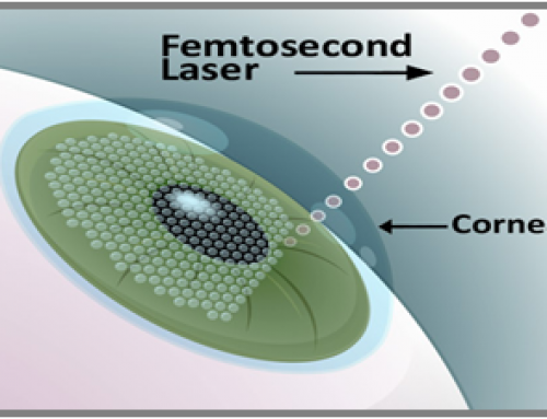 RECENT INNOVATIONS IN LASER-ASSISTED IN SITU KERATOMILEUSIS PROCEDURE