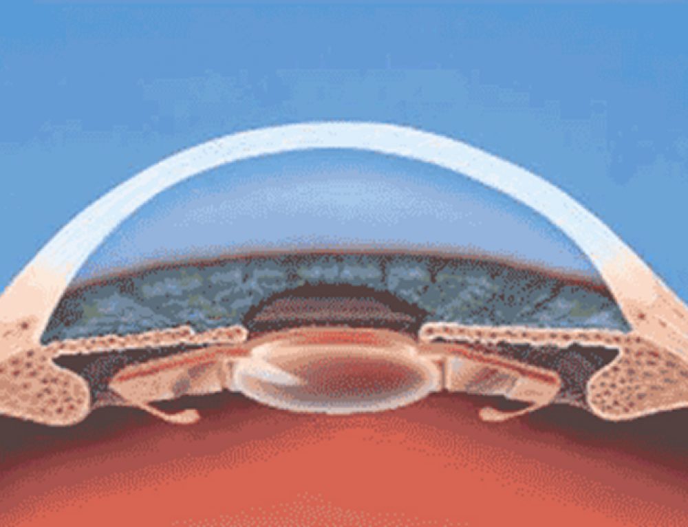 Prevention of Posterior Capsular Opacification Refractive Surgery Course